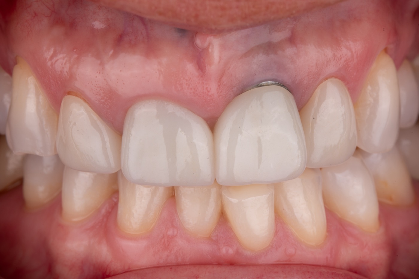 Anterior implant case requiring combined surgical and prosthetic treatment planning