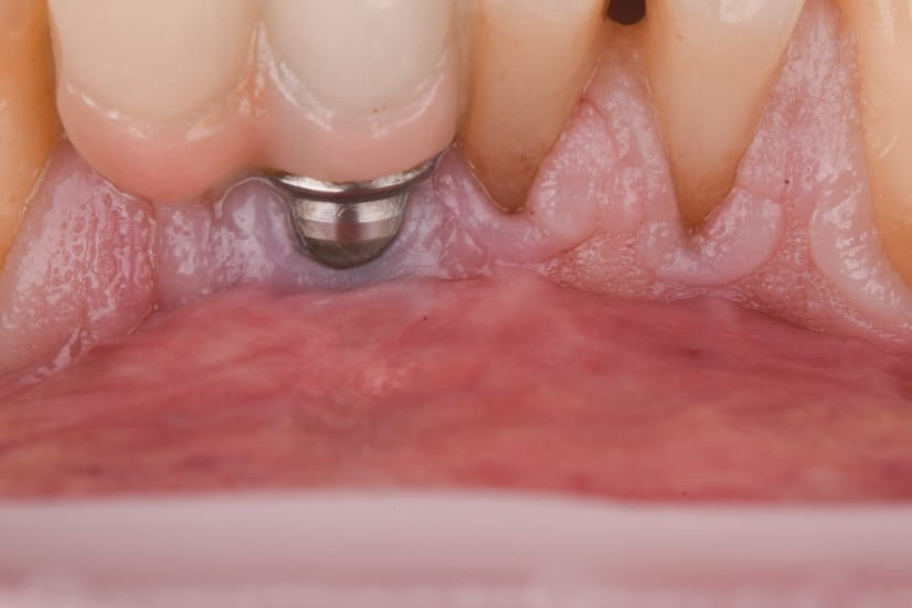 Inadequate peri-implant soft tissue with recession around a dental implant