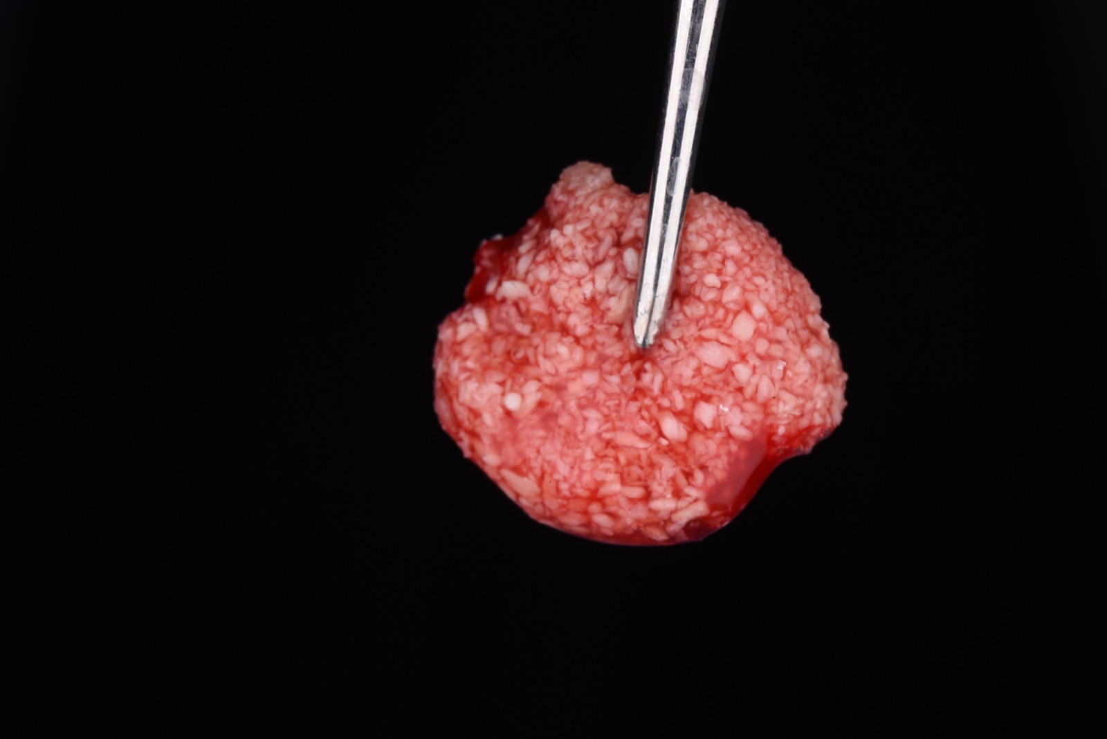 Sticky bone — bone graft particulate agglutinated with PRF, held on an instrument